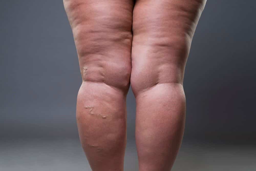 jambes lipoedeme en napso-therapie